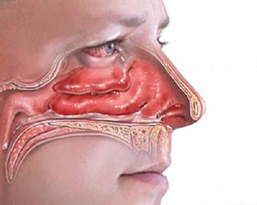 Viêm mũi dị ứng